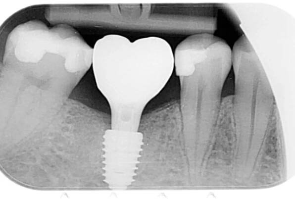 3D tiskem k perfektnímu úsměvu: Jak aditivní technologie pomáhají při zákrocích v zubním lékařství