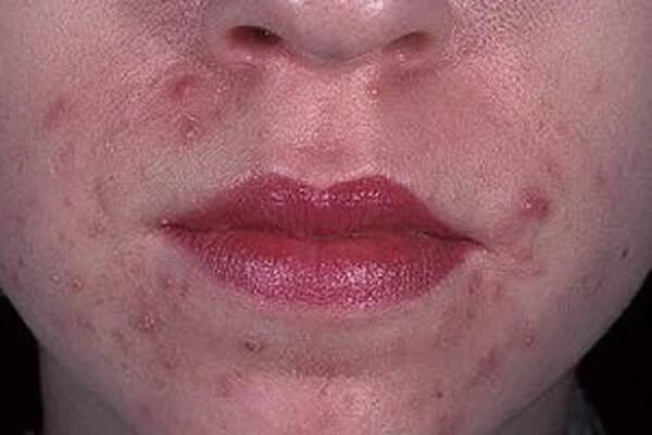 Alergická dermatitida / Dermatitida | Užitečné informace a tipy na péči o sebe. Zdraví, výživa a další.