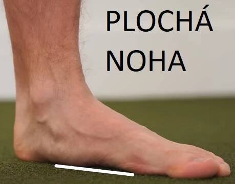 Ploché nohy - příčiny, příznaky, léčba a cvičení
