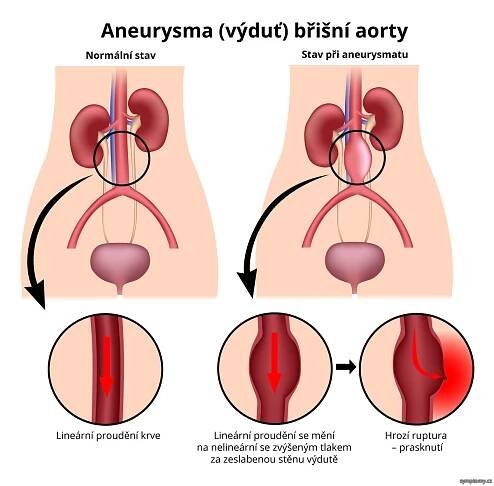 Aneurysma břišní aorty - příznaky a léčba