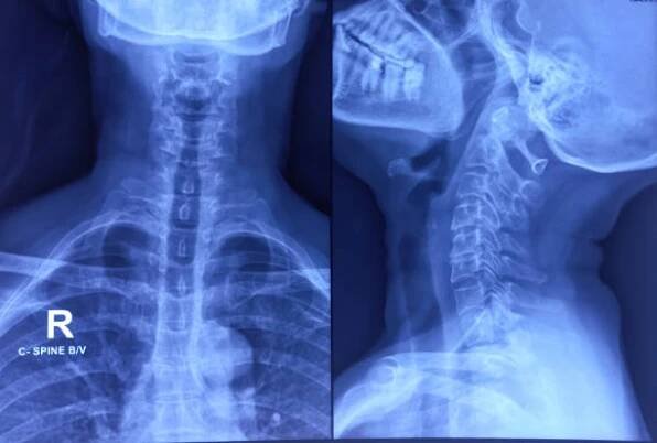 rentgen krční páteře se spondylózou krční páteře. okrajové osteofyty. cervikální spondylóza. - skřípnutý nerv - stock snímky, obrázky a fotky
