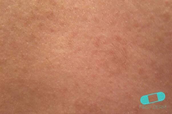 Pityriasis Versicolor (Tinea Verisicolor) - Online Dermatologist
