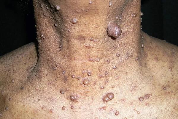 Neurofibromatosis