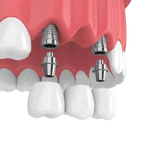 3D činí z implantátů s zubní můstek v horní čelisti izolované na bílém pozadí — Stock obrázek