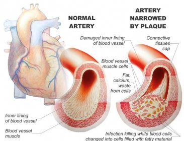 Coronary artery disease | Health Life Media