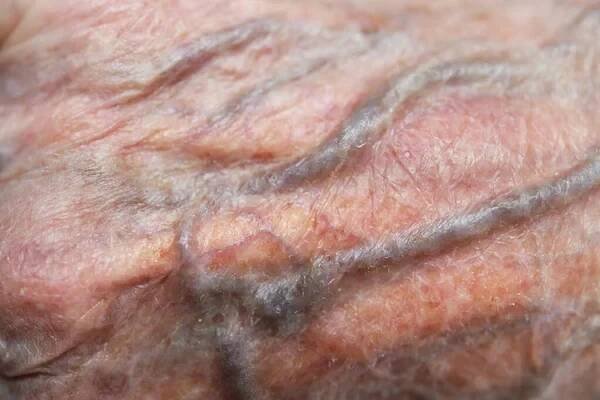 Close up of vein under skin of senior 90 year old man's wrinkled skin, white Asian women. — Stock Image