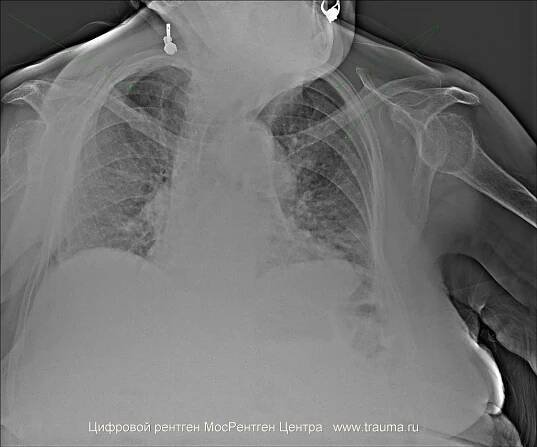 Emfyzém plic - příčiny, příznaky, diagnostika a léčba