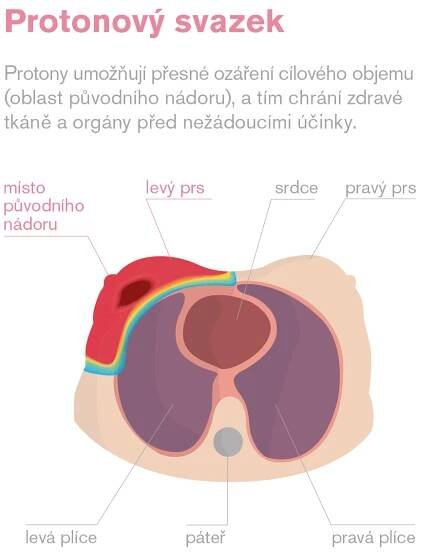 Proč zvolit protonovou léčbu - Protonové Centrum