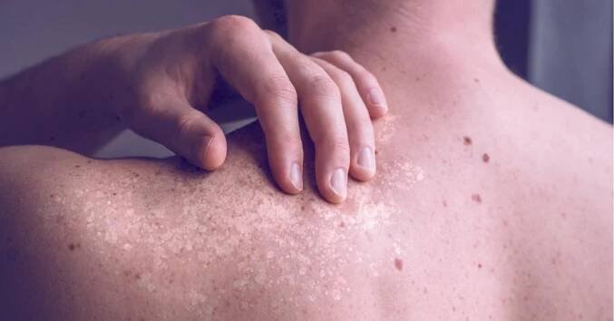What is tinea versicolor?