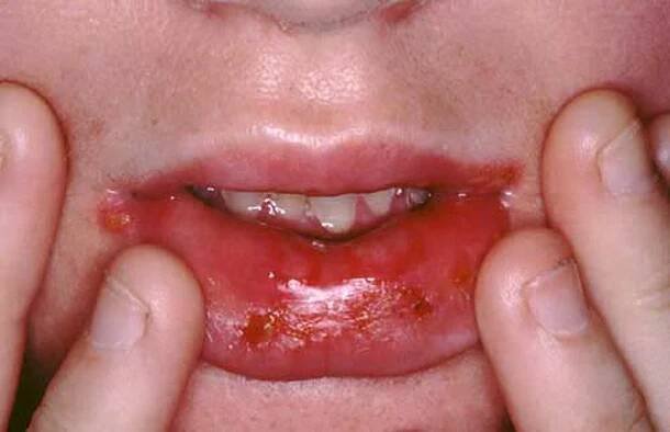 Léčba herpes stomatitis u dítěte: jak dlouho onemocnění trvá a jak se léčit