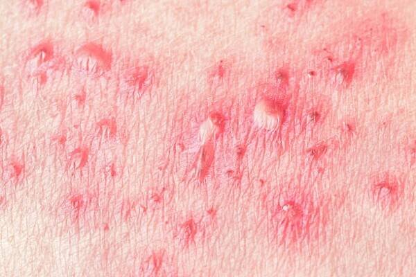 herpes zoster (šindele) - herpes zoster - stock snímky, obrázky a fotky