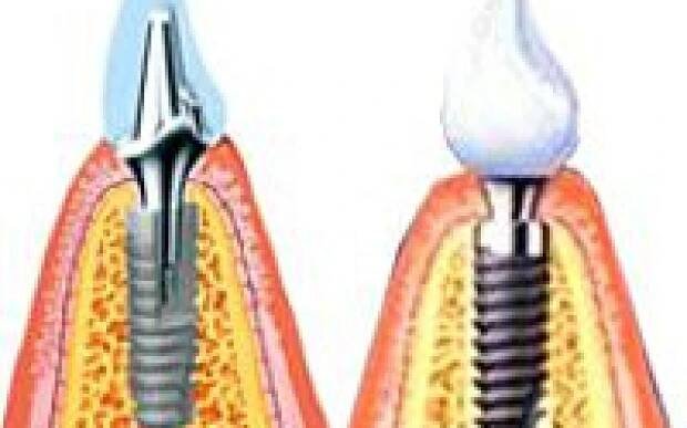 implantace zubů - klinika Rafael Zlín