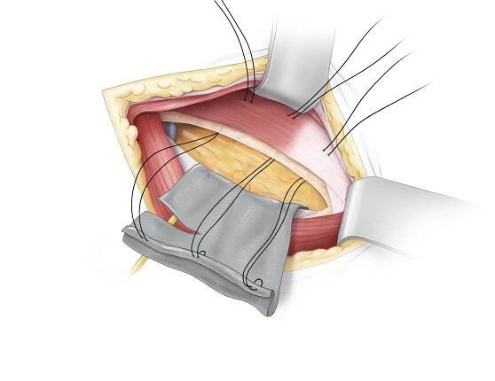 Hernien – mySurgery