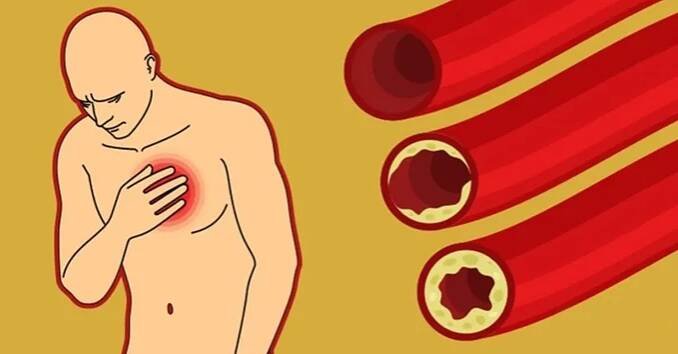 Potraviny, které okamžitě snižují hladinu nebezpečného CHOLESTEROLU v krvi! Jedná se zejména o TYTO