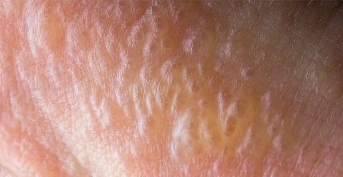 Dyshidrotická dermatitida nebo také dyshidrotický ekzém