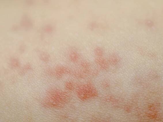 Psoriasis on baby's skin