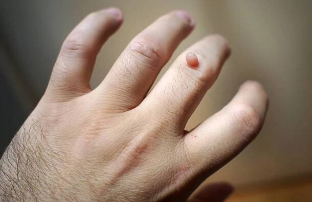 Zbavte se nehezkých kožních výrůstků. 8 snadných způsobů, jak se zbavit bradavic bez lékaře - AAzdraví.cz