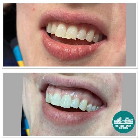 Smile Gallery | U Street Dentist — U Street Family Dentistry