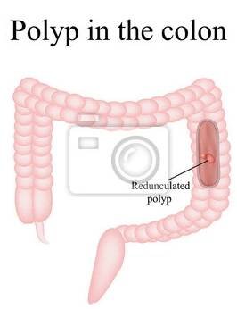 Polyp ve střevě. Polyp v tlustém střevě. Vektorové ilustrace
