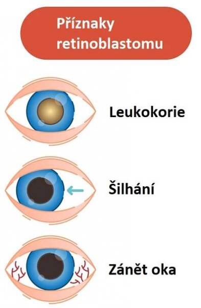 Leukokorie patří mezi příznaky retinoblastomu
