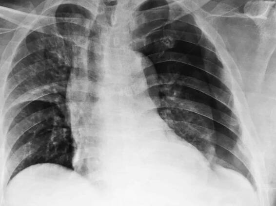Pneumotorax: Nahromaděný vzduch, o který nikdo nestojí - Info Pacient