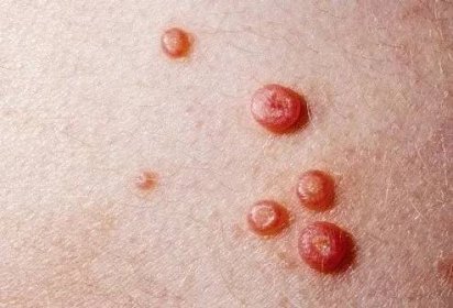 Another viral skin rash adults and children get is called molluscum contagiosum. 