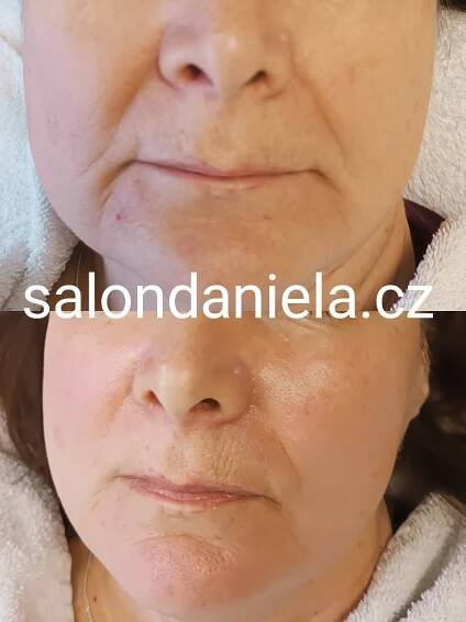 LIFTING - kolagenové nitě - neinvazivní! od 1300,- :: Salon Daniela