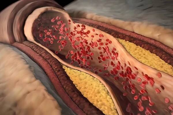 Jak na svém těle poznat varovné příznaky vysokého cholesterolu? - Hledám zdraví