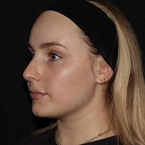 Emface bb results Emface. non-surgical facelift. botox near me. botox longmont. Fillers in longmont.
