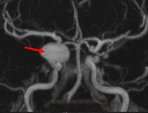 mra_aneurysm02_original
