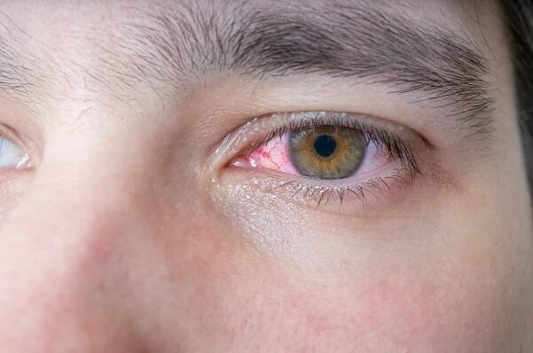 pink-eye-condition-closeup-man