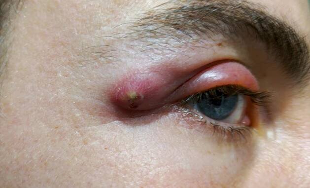 Absces, který se vytvořil blízko oka. Zdroj: Getty Images