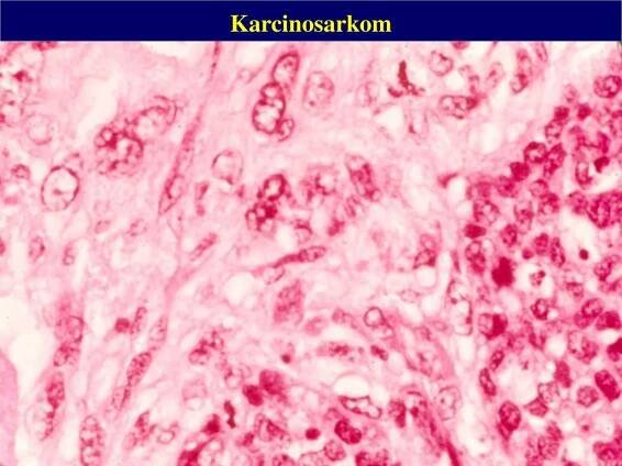 PPT - PATOLOGIE PRSU PowerPoint Presentation, free download - ID:1339421