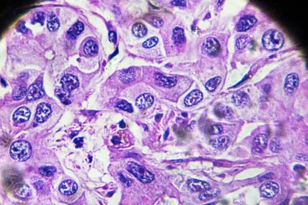 hepatocelulární karcinom, hcc pod mikroskopií - karcinom - stock snímky, obrázky a fotky
