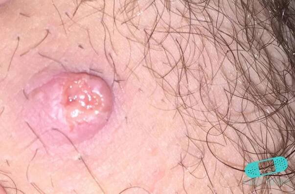 Keratoacanthoma (03) trunk [ICD-10 L85.8] characterized by a pinkish-red, raised lesion with a central crust or core. When the core of brown keratin comes out, it leaves a crater, making the lesion resemble a “mini-volcano