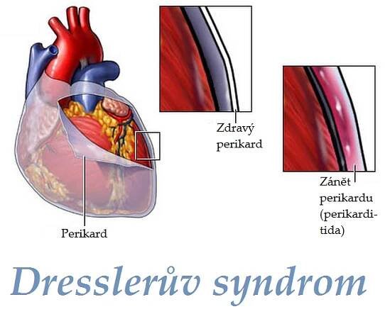 dressleruv syndrom priznaky projevy symptomy