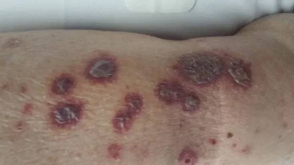 Erythema multiforme kožní léze s některými vezikulace a hemoragické změny — Stock obrázek