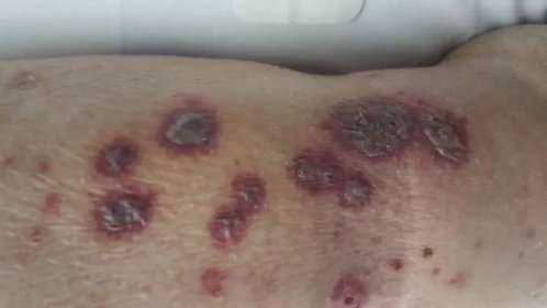 Erytém multiformní kožní léze s vezikulací a hemoragickými změnami — Stock obrázek