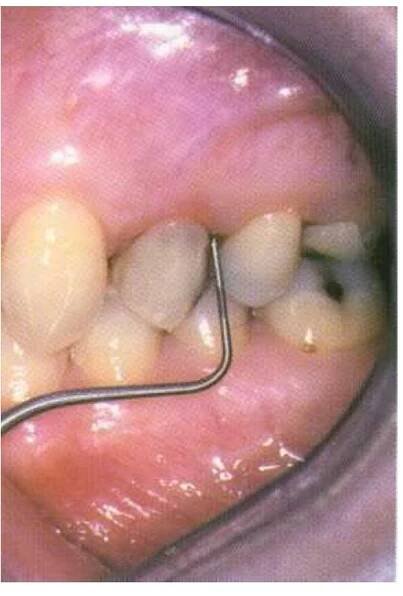 The probing depth of 7mm on the distal aspect of the tooth directly opposite to that on the mesial aspect was indicative of a vertical root fracture.  Figure 1.23  The maximum periodontal probing depth on the mesial aspect was 7mm. The pocket shape was deep and nar- row. 