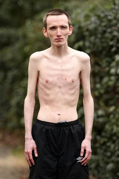 I muži trpí anorexií: Skončit to může i takhle