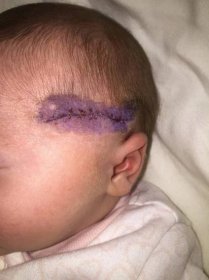 Doktorka při císařském řezu zranila dítě, na hlavičce mu udělala jizvu