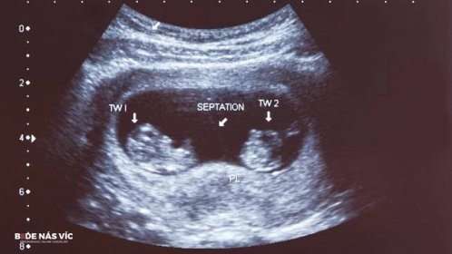 Vícečetné těhotenství - něžné překvapení, které se násobí | Blog | BUDE NÁS VÍC