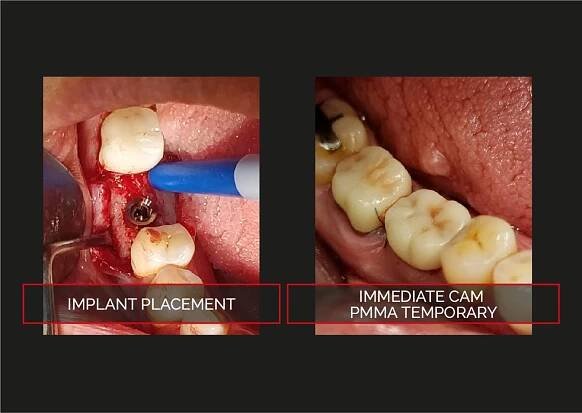 TRI Dental Implants: Klinische Fälle