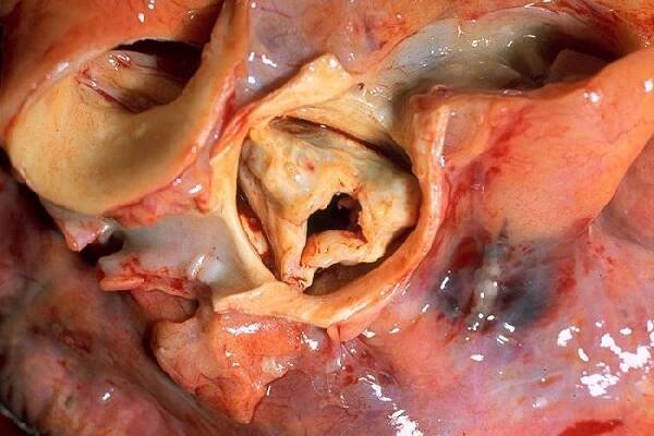 Súbor:Aortic stenosis rotated.jpg