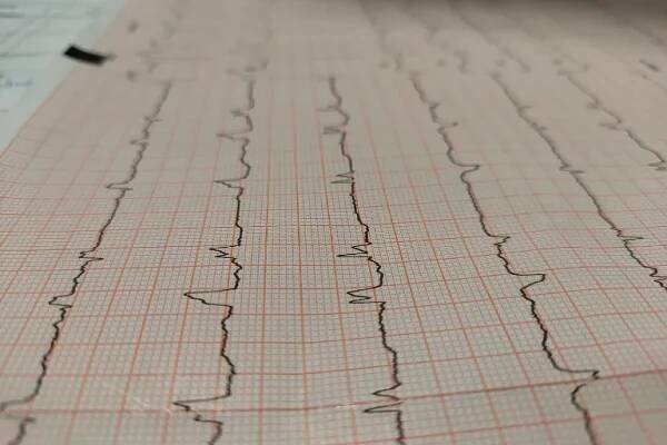 Zátěžové EKG: Jaký je průběh a výstup dat bicyklové ergometrie 2
