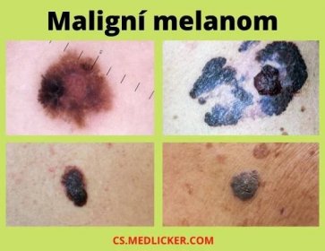 Maligní melanom může vypadat velmi různorodě. Proto je důležité pravidelně sledovat mateřská znaménka a další kožní léze, zda nedochází ke změně jejich charakteru či barvy