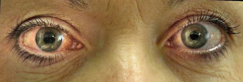 Zelený zákal (glaukom): diagnóza a léčba | NZIP