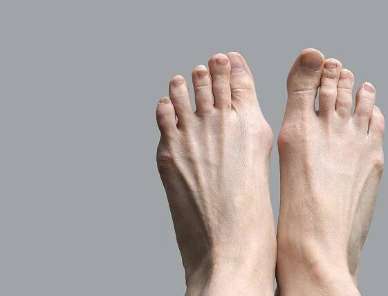 Guide Hallux Valgus & Hallux Valgus Treatments