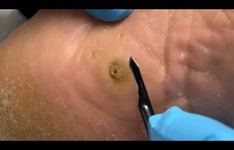 GET THIS HEEL SPUR OUT OF MY FOOT!