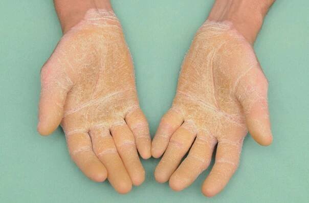 30 Facts About Epidermolytic Palmoplantar Keratoderma Vorner Type 